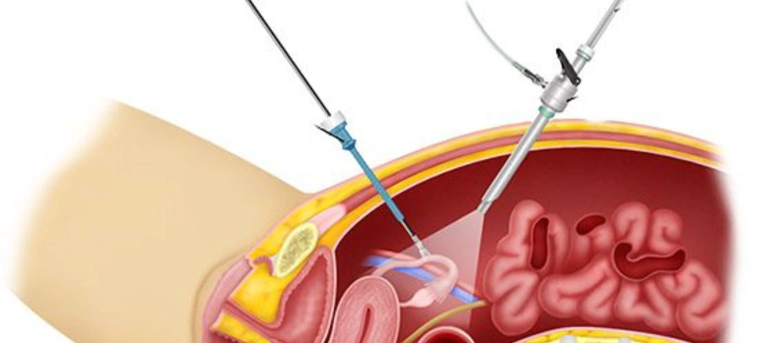 Operative Hysteroscopy