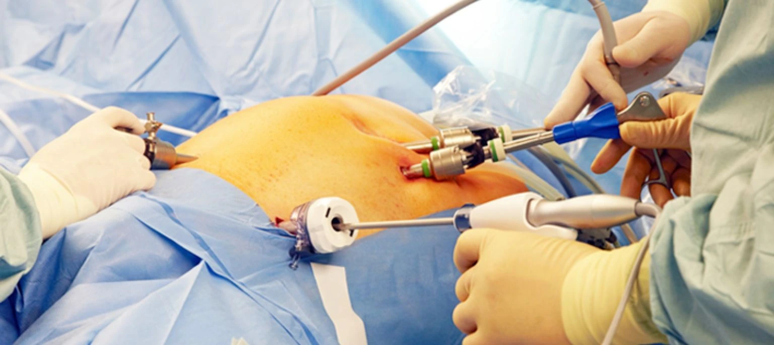 laparoscopic surgeries